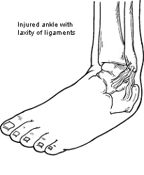 Chronic-Ankle-Instability